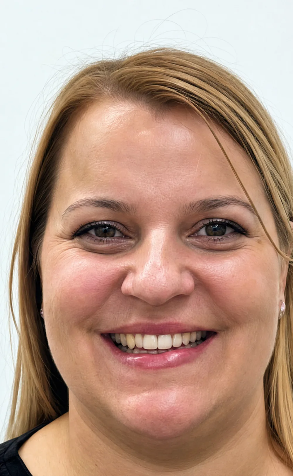 Po obravnavi Invisalign
