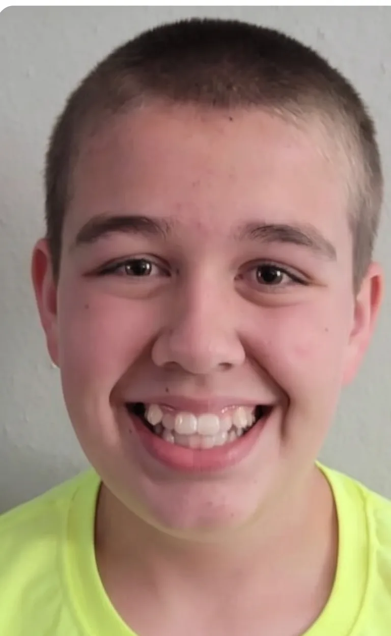 Pred obravnavo Invisalign